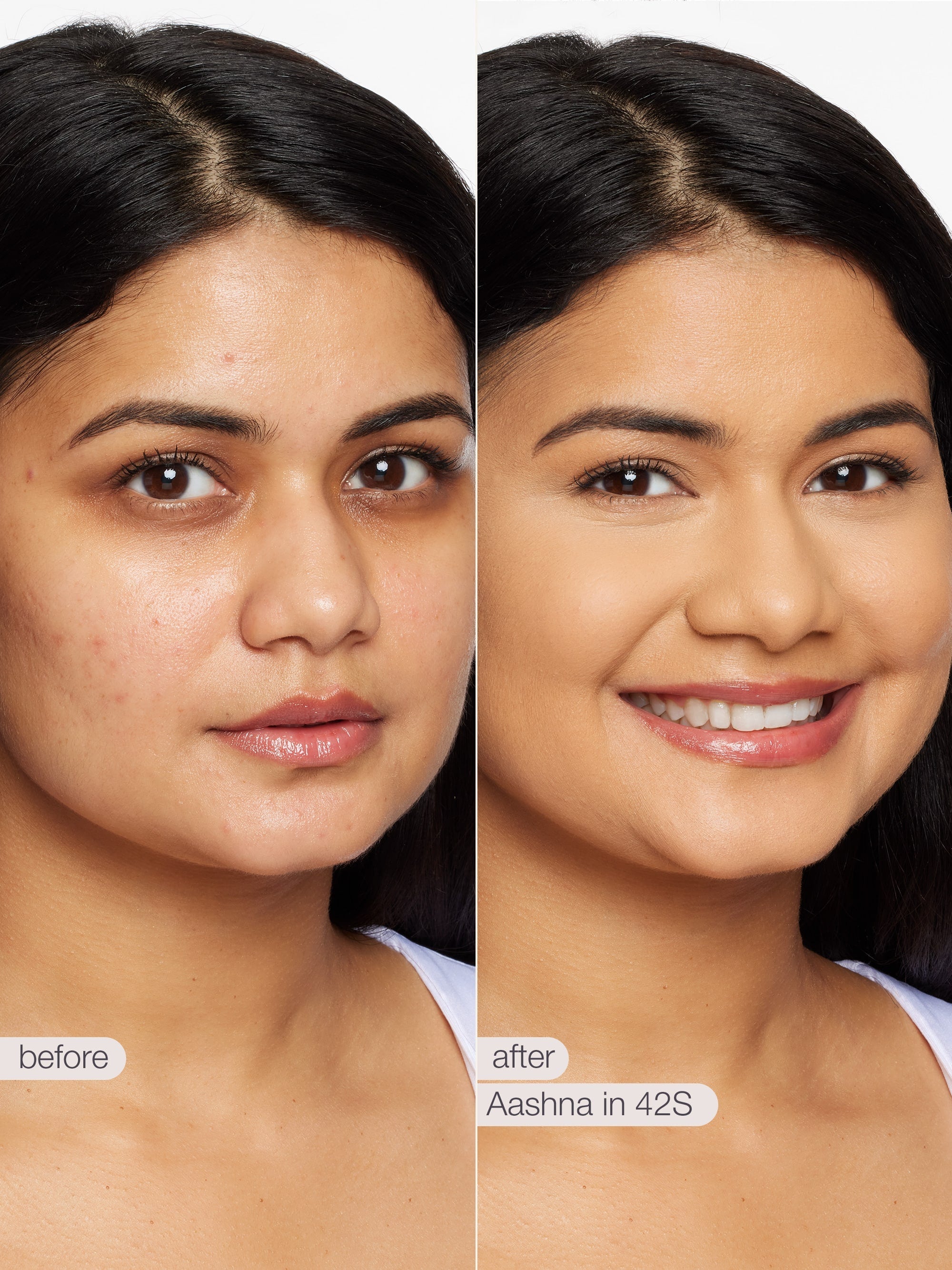 Before and after comparison of a woman's face with visible skin improvement using Aashna in 42S treatment. using tarte shape tape concealer