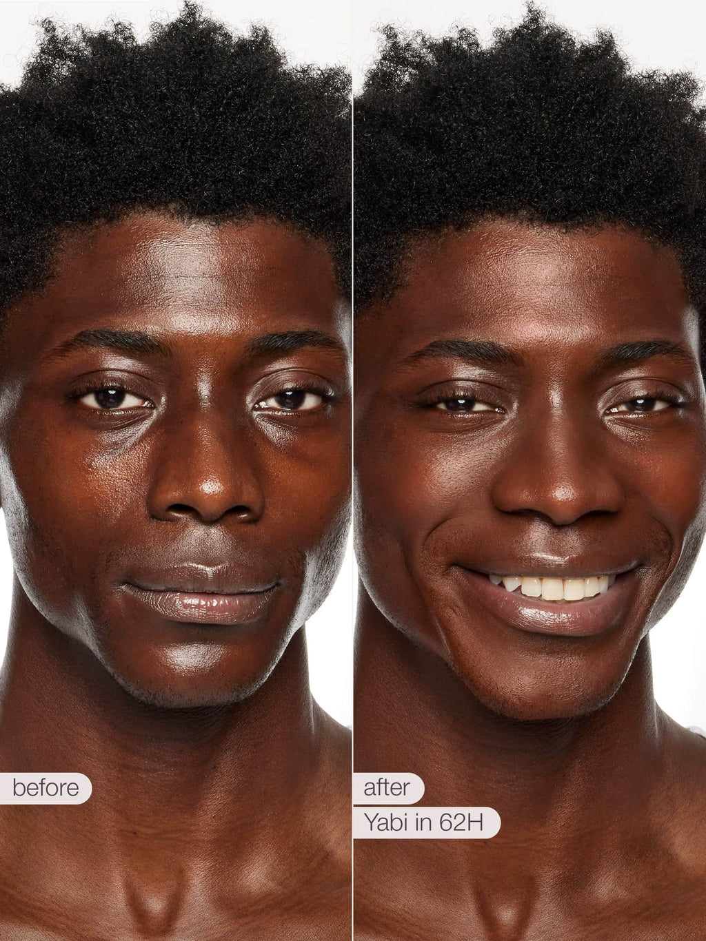 Before and after comparison of a person's skin with 'Yabi' treatment text.