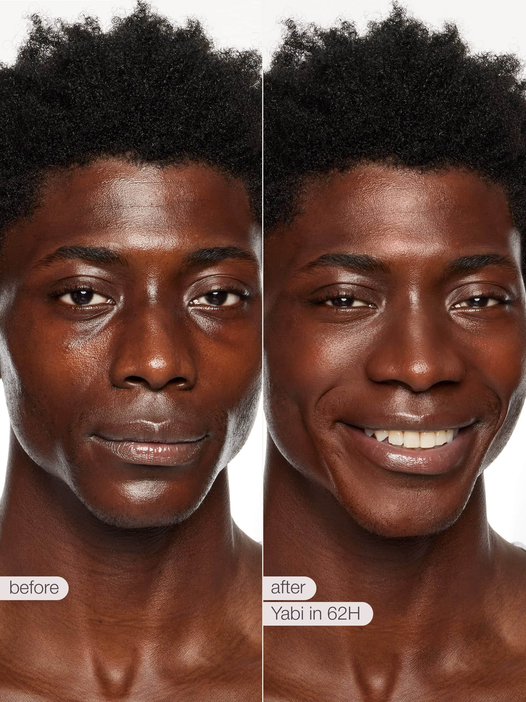Before and after comparison of a person's skin with 'Yabi' treatment text.