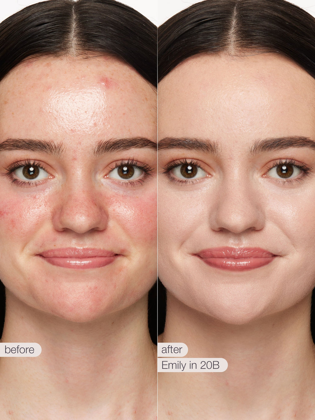 Before and after comparison of a woman's face with text 'before' and 'after' and 'Emily in 20B'.