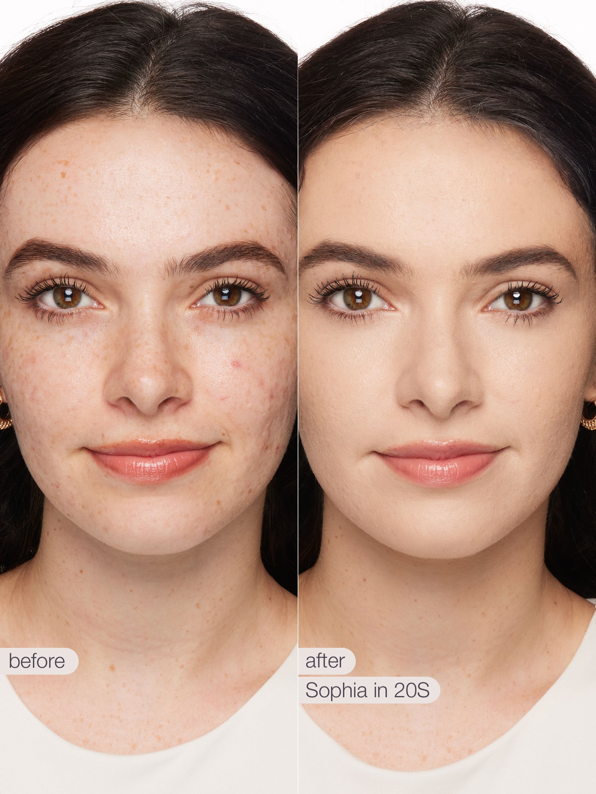 Before and after comparison of a woman's face with visible skin improvement, labeled 'before' and 'after' with 'Sophia in 20s' text.
