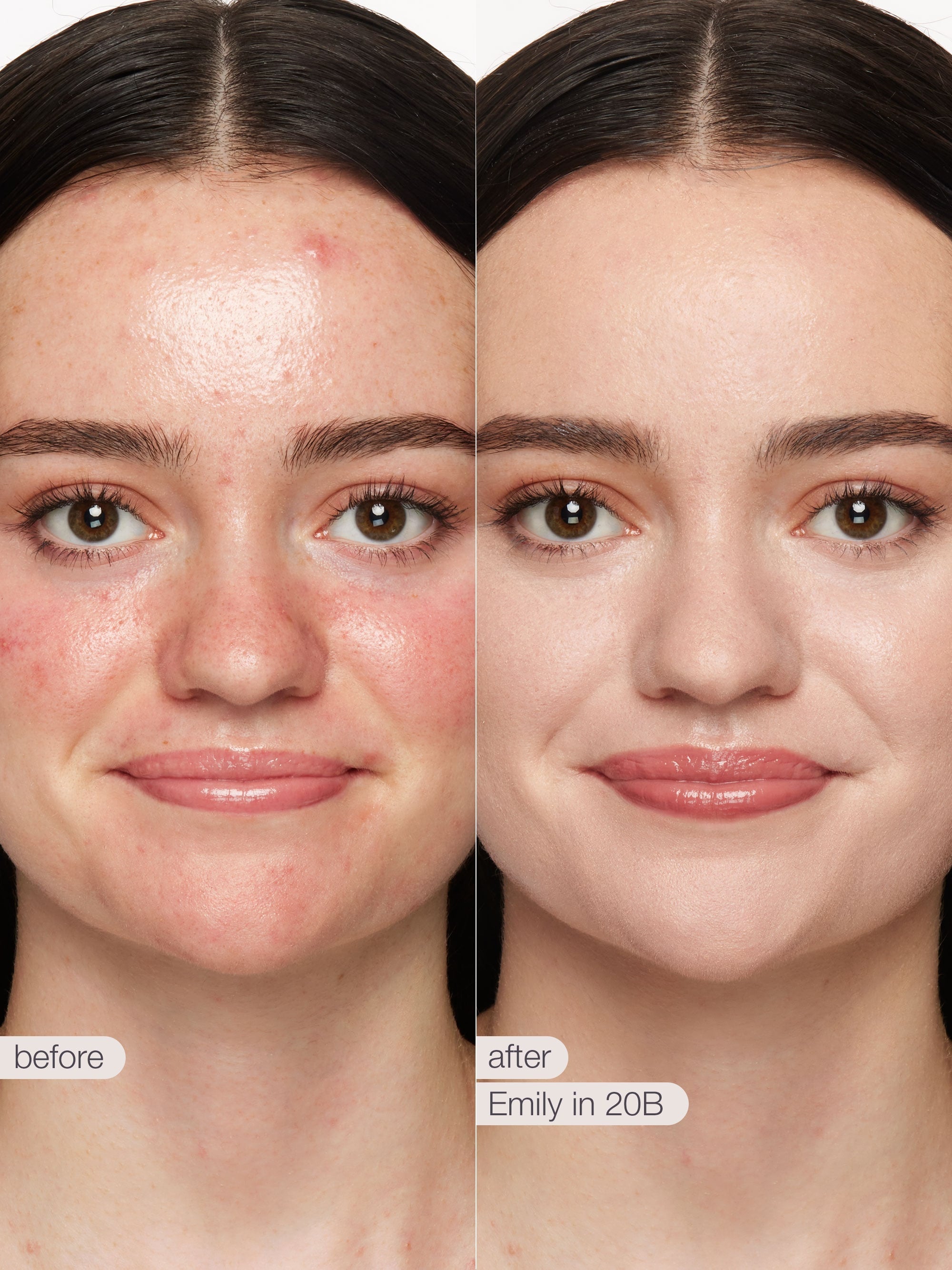 Before and after comparison of a woman's face with text 'before' and 'after' and 'Emily in 20B'.