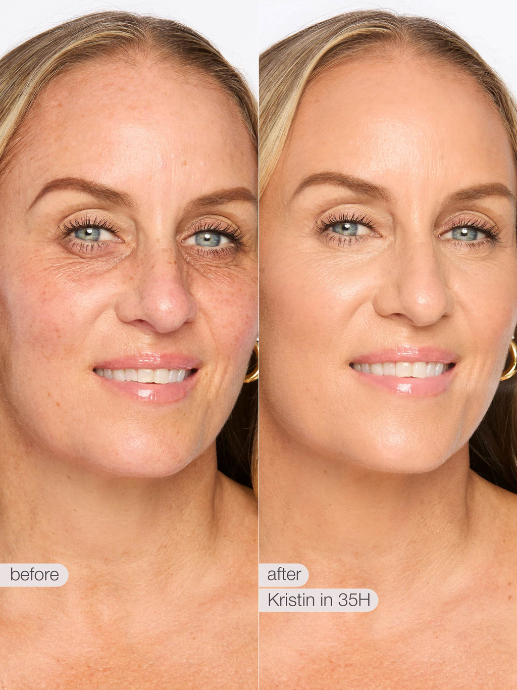 Before and after comparison of a woman's face with visible skin improvement.