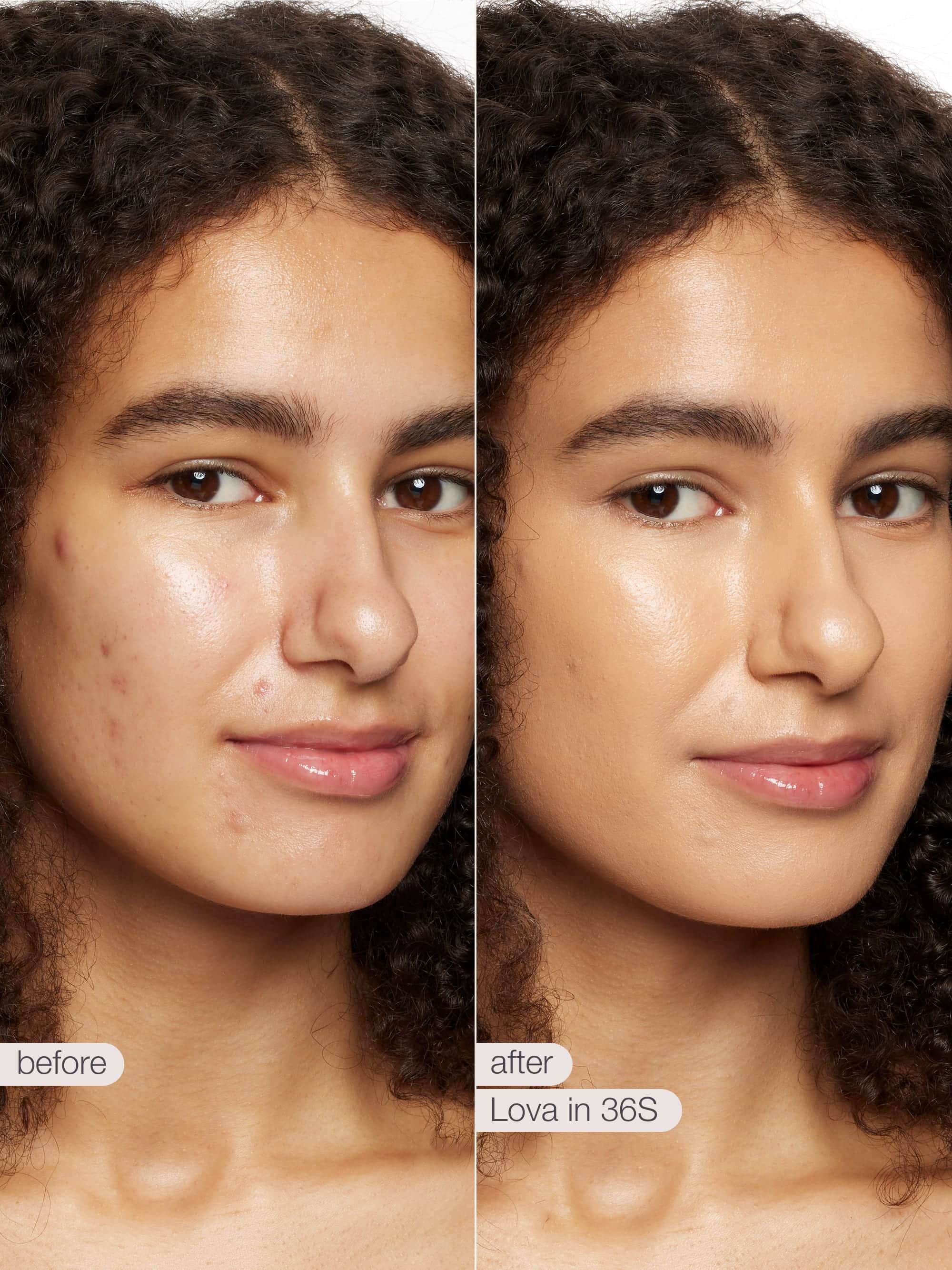 Before and after comparison of a woman's face with visible acne treatment using Lova product.