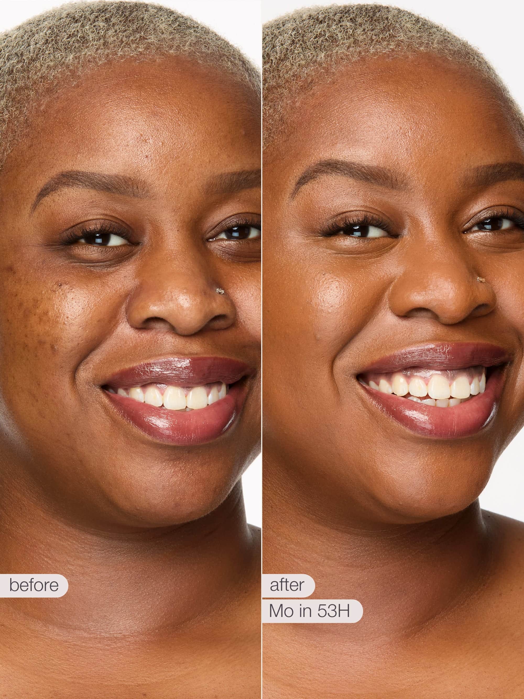 Before and after comparison of a woman's smile with text indicating 'before' and 'after' on a white background.